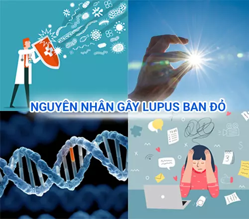Nguyen-nhan-gay-lupus-ban-do.webp